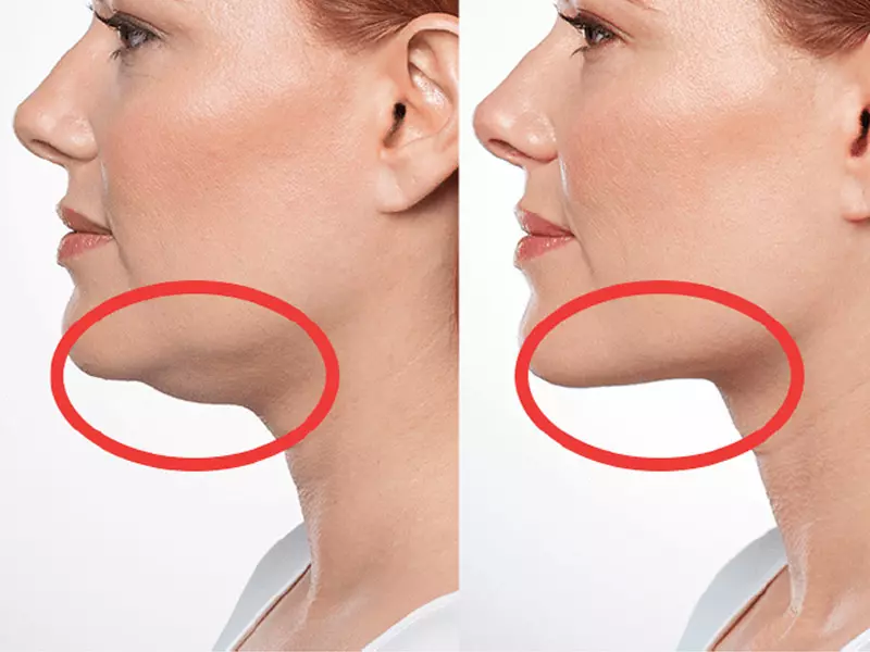 gidi eritme before after