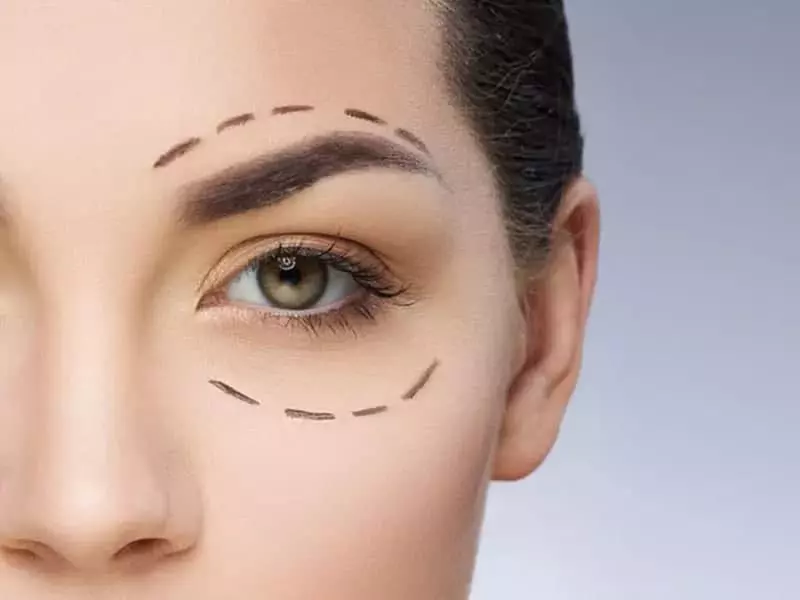 goz kapagi estetigi kac para