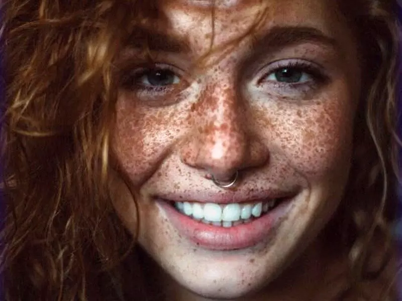 barcelona laser depigmentation
