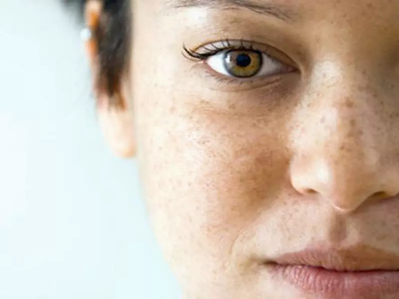 doha laser depigmentation