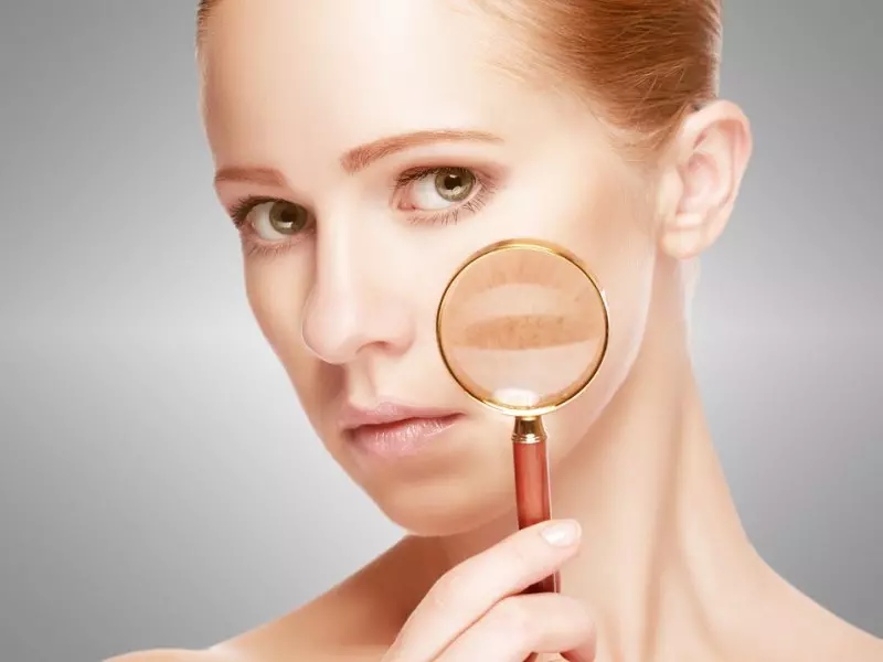 franfurt laser depigmentation