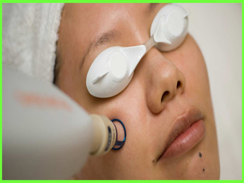 coventry laser depigmentation