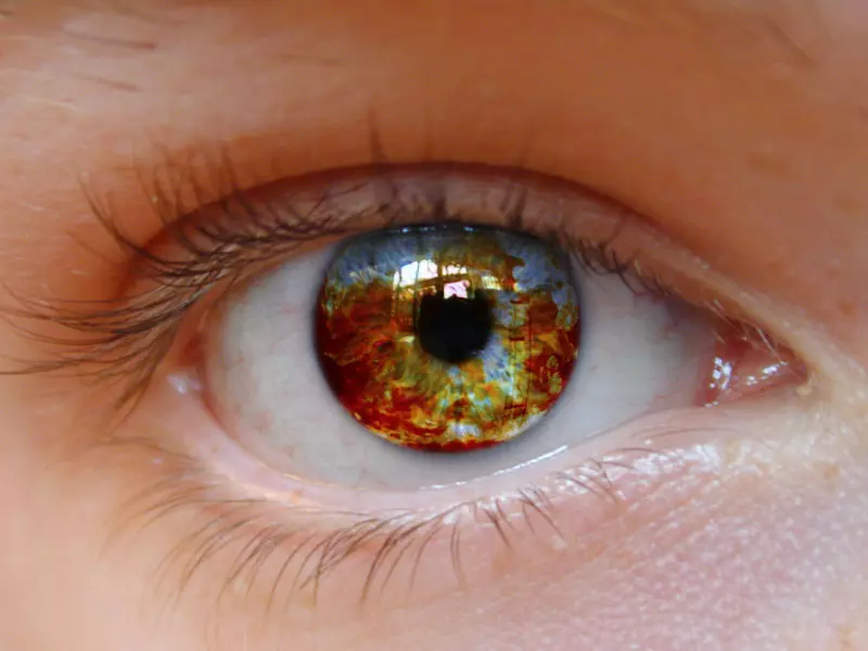 eye color change surgery price